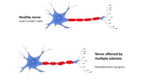 effect of multiple sclerosis on myelin