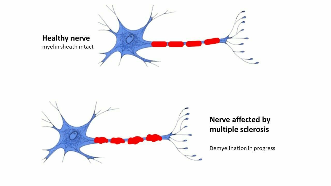 multiple sclerosis EAE induction